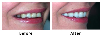 Porcelain veneers and dental crowns