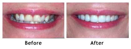 Porcelain veneers and dental crowns